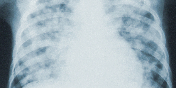 Jakie zioła na zwłóknienie płuc?